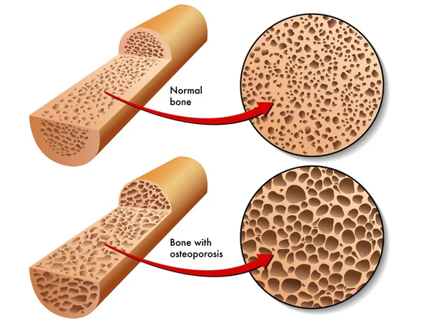 depositphotos_73928525-stock-illustration-colorful-osteoporosis-scheme